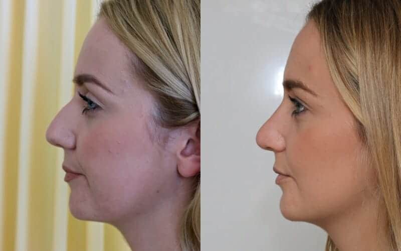 Rhinoplasty Washington DC Tailored to Your Facial Structure